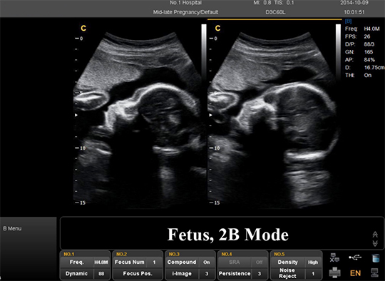 Quais são as diferenças entre os exames de ultrassonografia 2D, 3D e 4D?